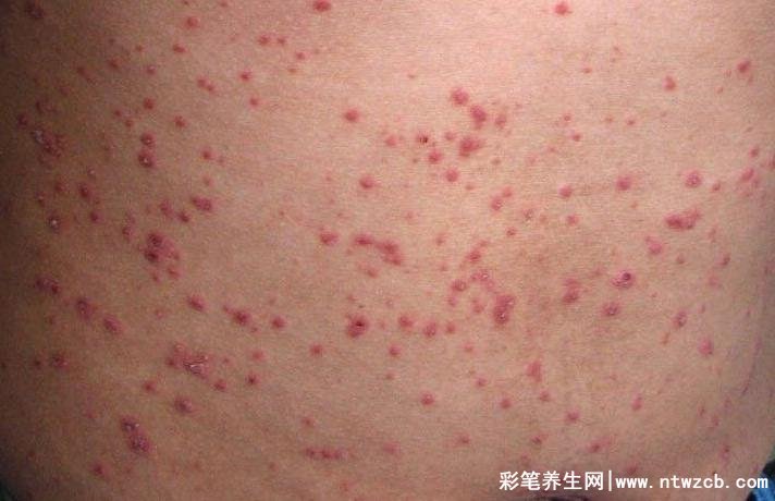 银屑早期症状图片，出现红色点丘疹/皮肤搔痒（4种情况）