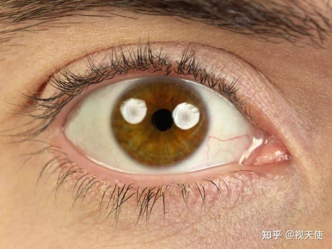 眼睛充血要警惕四种疾病，小心高血压/玻璃体积血/过敏性结膜炎