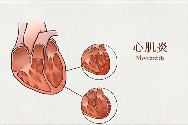 为什么心肌炎只有晚上难受，白天活动量过大夜晚身体疲惫